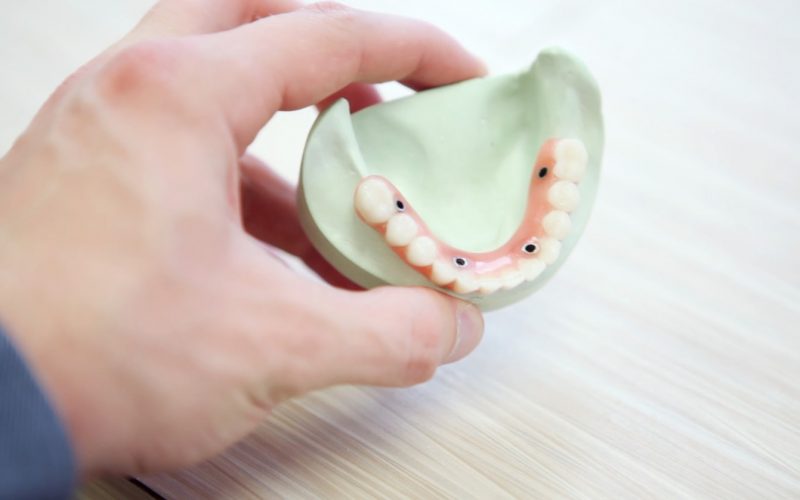 Comment Se Deroule La Pose D Un Implant Dentaire Paracetamol