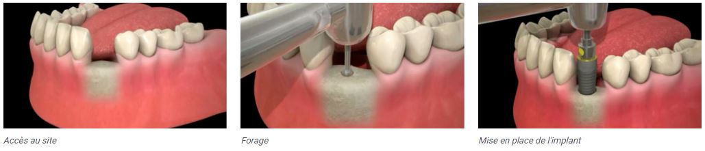 Les différentes étapes de la mise en place d'un implant dentaire